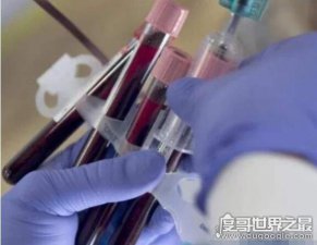 世界上最罕见的血型，A3亚血型(全球仅在我国有一例)