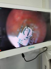 ​腹痛送医，老伯竟吞了一个打火机！医生“神操作”亮了……