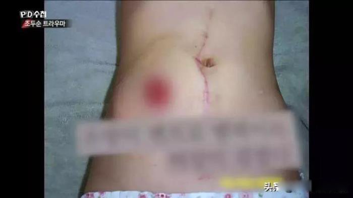 素媛案件真实女孩怎么样了 终身携带人造肛门生活