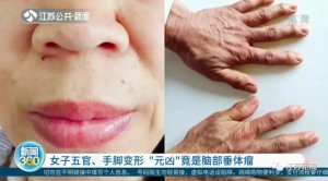 ​警惕！女子五官变形、手脚变大，不是发福，而是得了这个病！