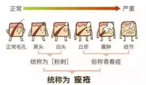 ​粉刺是什么样的（粉刺、痘痘、痤疮怎么区分）