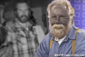 ​世界上有蓝血人吗，有(但不是外星人而是生病的地球人)