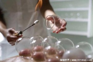 ​开背乳是什么刑法，拔火罐的超级加强版(轻则大包重则人肉分离)