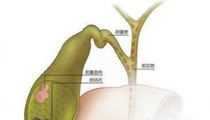 ​胆囊息肉一辈子没事(胆固醇性胆囊息肉会癌变吗)