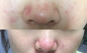 ​酒渣鼻怎么治疗(治疗酒糟鼻的简单方法)