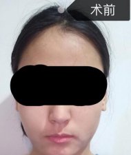​打了瘦脸针会不会有什么后遗症(打完瘦脸针的后遗症)