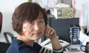 ​脸上有伤疤如何消除(脸上疤痕怎么去掉?)