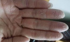 ​孩子冬季手脱皮严重怎么办(孩子冬季皮肤干燥脱皮咋办)