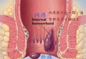 ​痔疮出血严重怎么办(痔疮大便拉血怎么办)
