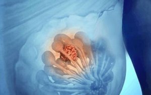 ​乳腺增生是什么意思(乳腺增生什么意思?)