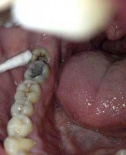 ​智齿是拔掉好还是不拔好(智齿医生建议不拔)