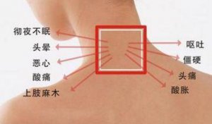 ​如何保护好颈椎?(颈椎病怎么保护)