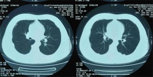 ​哪些情况需要做肺部CT