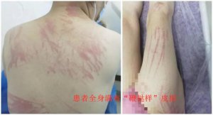 ​一顿烧烤后，女子全身遍布“鞭打”痕迹，竟是因……