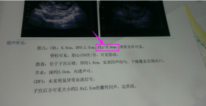 ​fl是胎儿的什么(bpd是胎儿的什么)