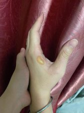 ​灼伤是什么意思（什么是灼伤）