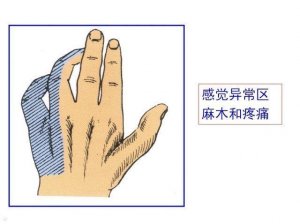 ​尺神经损伤是指卡压断裂还是手麻（陶勇伤后近8月未恢复触觉）