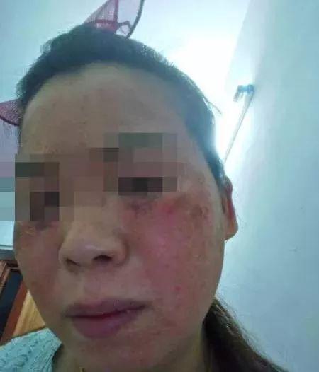 美容变毁容案例（东莞女子花上万元祛斑）(4)