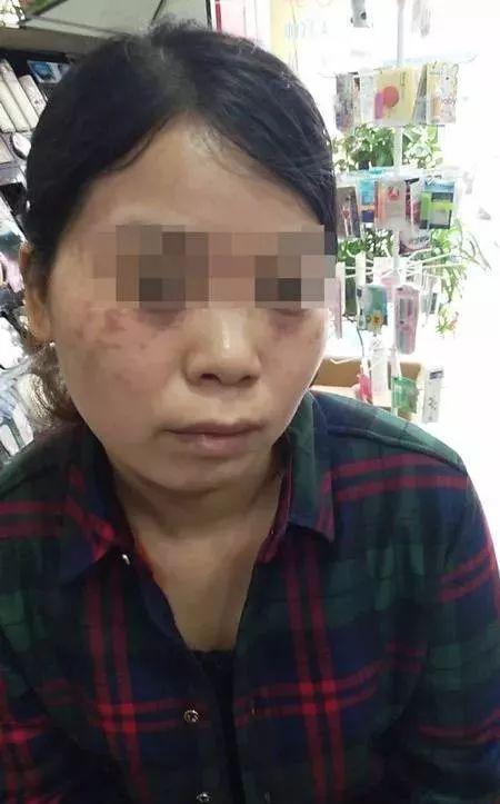 美容变毁容案例（东莞女子花上万元祛斑）(8)