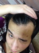 ​小孩额头头发稀少怎么办(额头头发稀少怎么办适合长发还是短发)
