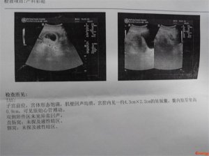 ​孕囊拍出来是什么样？孕囊形状看男女超准