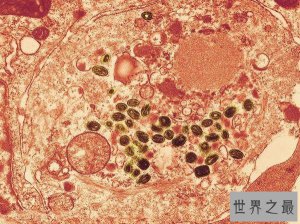 ​世界上10大最恐怖的病毒，第一让近数亿人死亡，艾滋病仅第五
